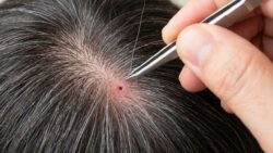 Why plucking a single gray hair does not make two grow back, but can permanently damage the follicle so nothing grows back at all