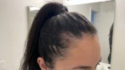 Why tying your hair up in the exact same spot every day causes “traction alopecia” and permanent hair loss along the hairline